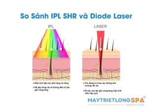 So Sánh Công Nghệ Triệt Lông IPL SHR Và Diode Laser