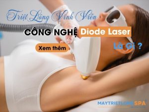 Công nghệ triệt lông diode laser là gì