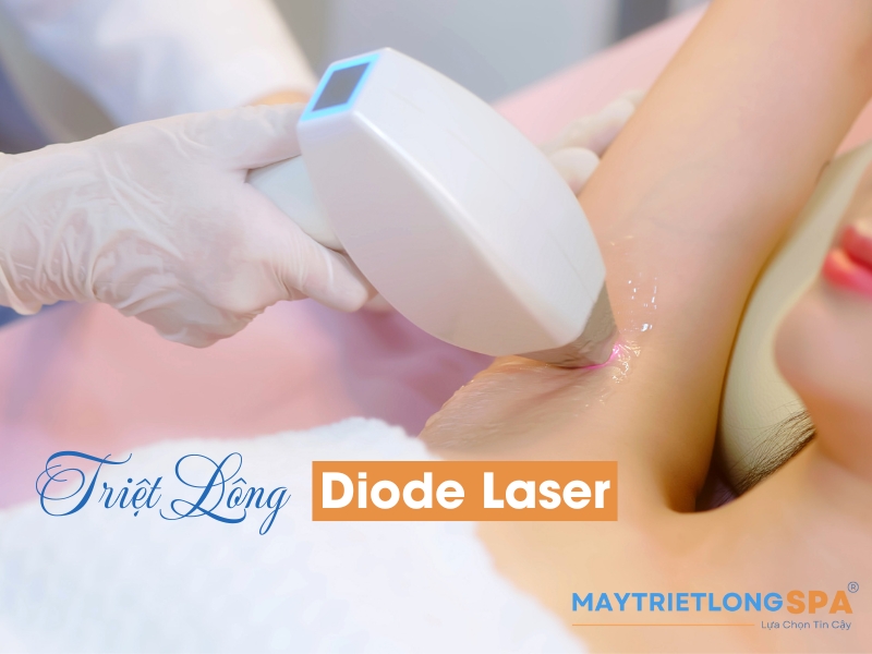 Công nghệ triệt lông diode laser là gì