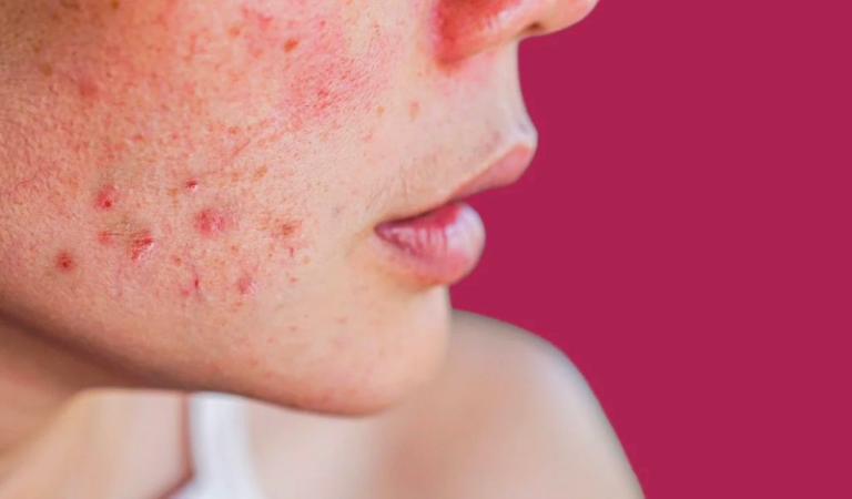 Phan-phoi-may-triet-long-spa-tai-Quang-Tri