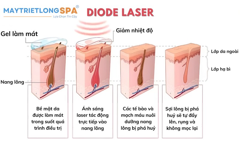 Công nghệ Diode Laser mang đến tỷ lệ triệt lông lên tới 99% tương thích trên mọi loại da