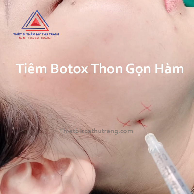 Cách tiêm botox gọn hàm